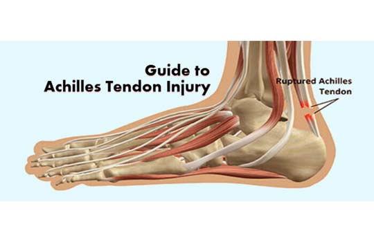 The Ultimate Guide for Achilles Tendon Injury |Treatment options|London, Uk