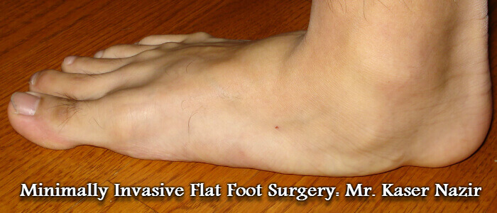 flat foot reconstruction surgery recovery