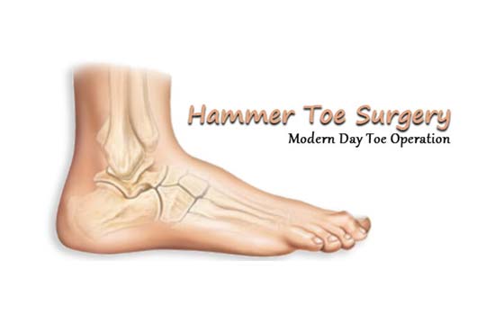 Hammer Toe Treatment - Looking Glass Foot & Ankle Center