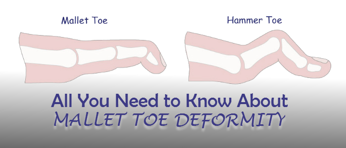 all-you-need-to-know-about-mallet-toe-deformity