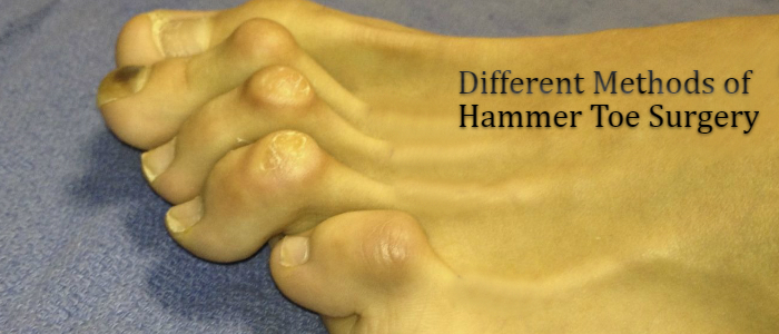 hammer toe surgery