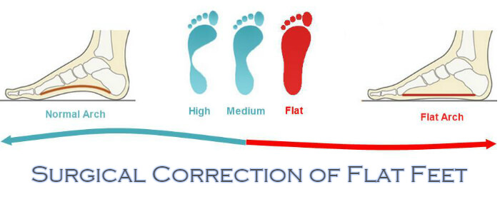 Surgical Correction of Flat Feet: LondonFootandAnkleSurgery.co.uk