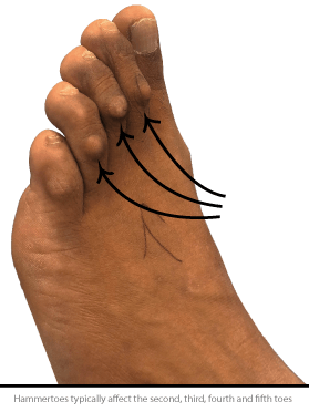 Hammer Toe - Symptoms, Causes and 