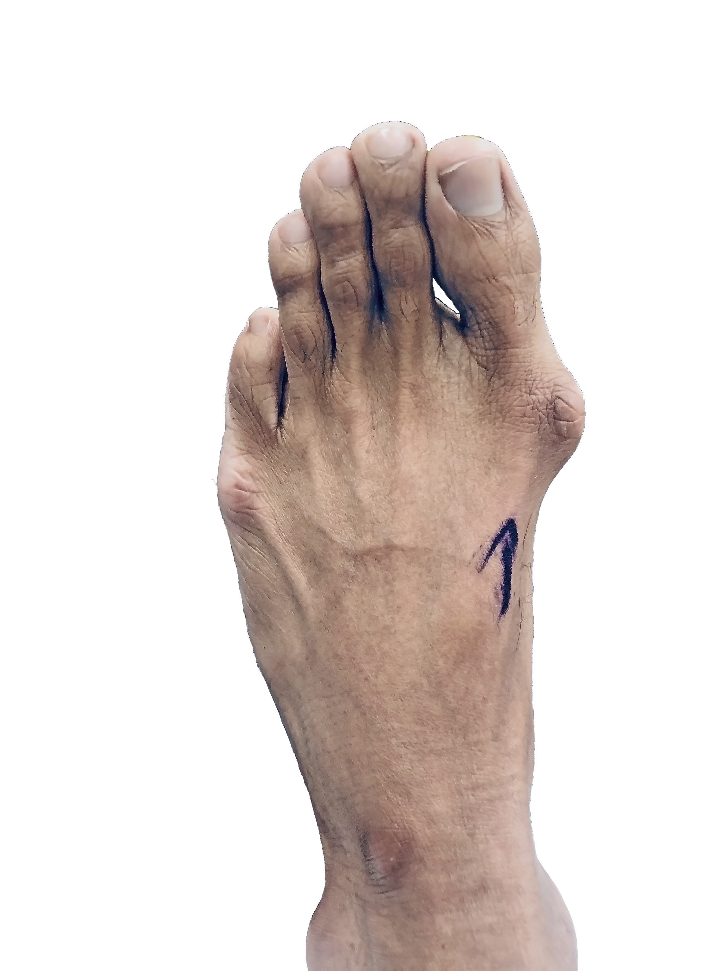 bunion example